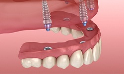 Upper denture being attached to implants