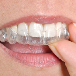 invisalign in mouth