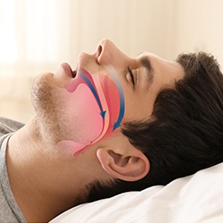 A man lying in bed asleep with his mouth open and snoring