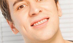 Closeup of man with Six Month Smiles braces