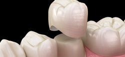 3D model of a dental crown topping a tooth