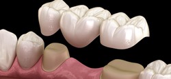 3D model of a dental bridge in Greenfield