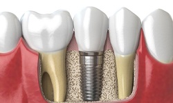 A dental implant