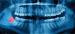 X-ray of impacted wisdom tooth