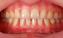 A mouth with mild gum disease.