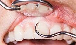 A closeup of a mouth receiving periodontal therapy.