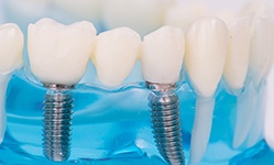 Model showing each part of a dental implant