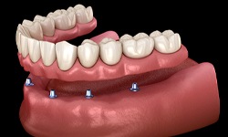 Digital image of a lower denture being attached to implants