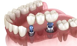 a computer illustration showing an implant bridge