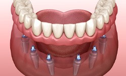 a computer illustration showing an implant denture