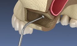 a computer illustration showing a sinus lift