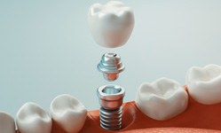 a computer illustration showing each part of a dental implant