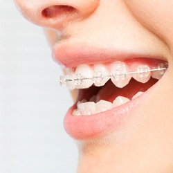 Close-up of woman’s smile with clear braces on both dental arches