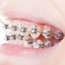 Traditional metal braces being used to correct crooked teeth
