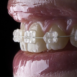 Six Month Smile braces on teeth