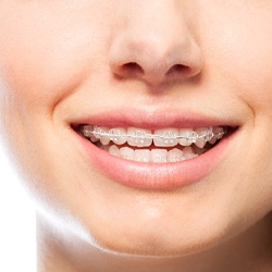 Close-up of smile with Six Month Smiles clear braces