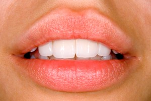 dental veneers in Greenfield