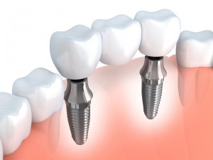 Avoid the difficult consequences of missing teeth. Explore the advantages of Deerfield dental implants with Drs. Bagley, Goodwin and Hrinda.