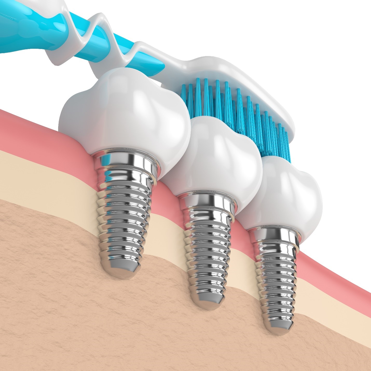 Pick the Right Toothbrush for Dental Implants in Greenfield