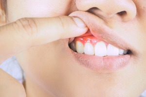 Pulling up lip to show inflamed gum tissue