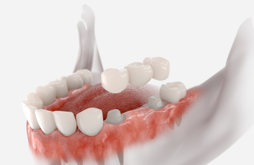 3D image of a dental bridge